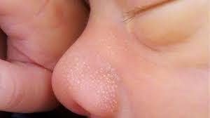 Image result for milium cyst on eyelid