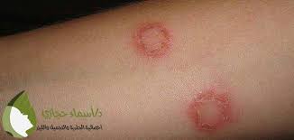 انواع فطريات الجلد بالصور