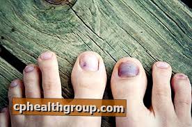 Ukoliko već imate dijagnozu dijabetesa , odmah posetite lekara ukoliko posekotina , rana , plik ili modrica na vašem stopalu ne počinju da zarastaju ili se ne povlače nakon 1 dana. Kako Lijeciti Ljubicast Nokat