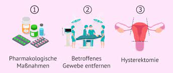 Das charakteristischste zeichen der adenomyose ist verlängert (mehr als 7 tage), schmerzhafte und sehr schwere menstruation. Was Ist Die Uterine Adenomyose Risiken Symptome Und Behandlung Invitra