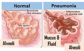 Hasil gambar untuk PNEUMONIA