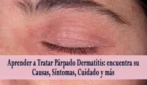 Aprender A Tratar Parpado Dermatitis Parpados Ascensor Blog