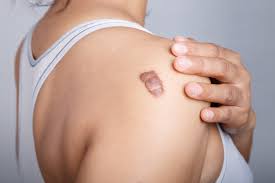 Penyebab Keloid Masih Muncul Lagi Meski Sudah Dioperasi