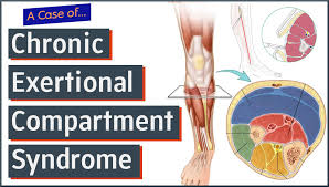 Image result for Compartment Syndrome