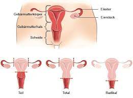 Gebarmutterentfernung Hysterektomie Gesundheitsinformation De