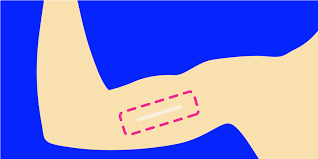 Also if it matters i've had it for a year and have been breastfeeding the entire time. Nexplanon 5 Things To Know About The Birth Control Implant Self