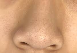 Hair on top of the nose often develops as a result of genetics or hormone imbalances, and it can occur in both men and women. Black Concern Due Hair Nose Pores Black Concern Due Hair Nose Pores 2020