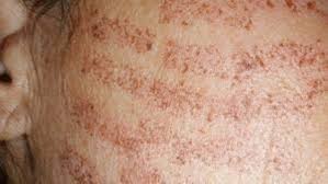 As you continue your treatments, more and more hair will fall out, and you'll notice that it continues to grow back more slowly. How Common Are Laser Hair Removal Burns Lifestylemission