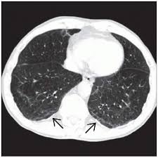 1, 2 asbestos is the name given to a group of naturally occurring minerals that are resistant to heat and. Asbestosis Radiology Key