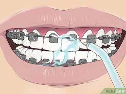 Wrap the ends of the floss tightly around your middle fingers. 4 Ways To Floss With Braces Wikihow