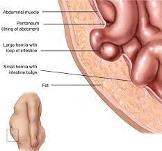Image result for stomach hernia symptoms