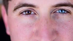 Eyes these pictures of this page are about:central heterochromia eyes. Heterochromia Symptoms Causes Diagnosis Treatment