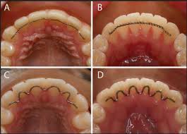In that regard, we've included a price list below to give you an idea of what the cost might be if you need to replace your retainer. Maintaining Your Smile After Orthodontic Treatment Drummoyne Dental Practice