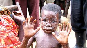 Monkeypox virus belongs to the orthopoxvirus genus in the family poxviridae. Kj8ormwv3lggvm