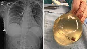 Women who want a very natural look and feel typically choose teardrop breast implants over round implants. Woman S Breast Implant Deflects Bullet Saving Her Life Cnn