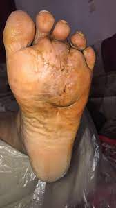 The purpose of this work is to increase the awareness of this infection that is still not diagnosed in our context by moroccan practitioners, as well as to show the medical treatment limits in madura foot. Chronic Madura Foot Mycetoma And Or Actinomyces Spp Or Actinomycosis Bmj Case Reports