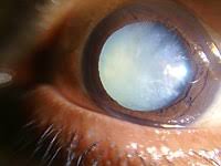 Katarakt ameliyatında hastanın gözüne takılacak olan mercek numarası hesaplanarak kişinin uzağı daha net görmesi sağlanmaya çalışılır. Cataract Wikipedia