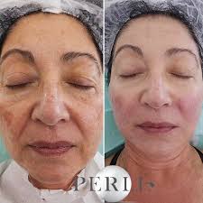 Достоинствено низ годините Full face lifting #filler #botox #antiaging  #beautification #conturing @teoxane.macedonia @dr.daniela.dimitrova