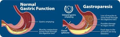 Check spelling or type a new query. Diabetes Gastroparesis Symptoms Causes Treatment Us Med
