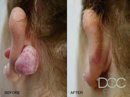 Best Treatment For Keloids Hypertrophic Scarring The Doc Clinic The Doc Cosmetic Skin Clinic