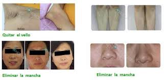 It requires a series of appointments over a period of time. Portable Electrolysis Hair Removal Machine For Facial Hair Remover Ce Iso Tuv China Hair Removal Wrinkle Removal Made In China Com