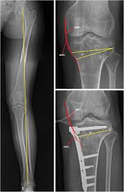 If this happens in the knee or ankle, you can get a swollen left leg as a result. Medial Collateral Ligament Laxity In Valgus Knee Deformity Before And After Medial Closing Wedge High Tibial Osteotomy Measured With Instrumented Laxity Measurements And Patient Reported Outcome Journal Of Experimental Orthopaedics