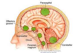 How To Prevent Brain Tumors, Tells Neuro Surgeon – Pakistan Today