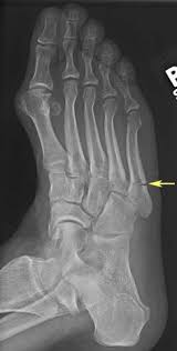 Outside of the foot pain can be improved with a few simple treatment. 10 Jones Fracture Ideas Jones Fracture Foot Exercises Fracture