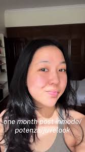 the healing took about 2 weeks but mostly just small bruises and black dots  from the potenza!! I’d say im super happy with the glow but do we see a  difference with the jawline after inmode?? I think ...