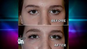Figure out which eye shape you have, so you can learn more about different shading techniques it all depends on how you want to shade and shape your eye, but there are a few general guidelines Almond Shaped Eye Surgery Before After Graphic Video Realself