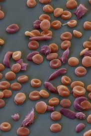 Sickle cell anaemia is an autosomal recessive disorder, which causes deformation to the shape of the red blood cells, preventing the cells from being able to travel through smallblood vessels. How One Child S Sickle Cell Mutation Helped Protect The World From Malaria The New York Times