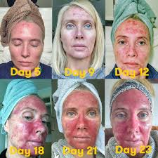 See pictures of skin cancer and get the facts on skin cancer symptoms, signs, treatment, prevention, causes (tanning, genetics), and types (melanoma, squamous cell and basal cell what is the treatment for skin cancer? These Graphic Photos Of Skin Precancer Treatment Are A Must See Self