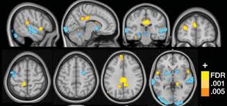 Aus wikimedia commons, dem freien medienarchiv. Neural Signature For Fibromyalgia May Aid Diagnosis Treatment Eurekalert Science News