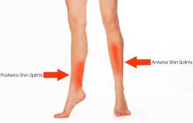 How To Get Rid Of And Prevent Shin Splints Legion Athletics Shin Splints Shin Splint Exercises Shin Splints Treatment