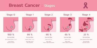 Image result for Breast Cancer Staging
