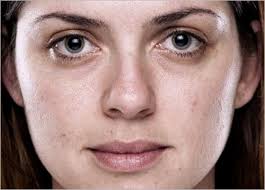 Pico Laser: Rawatan Parut Jerawat & Pigmentasi