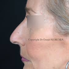 Photos avant-après chirurgie du visage et ORL