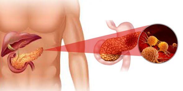 Cancer du pancréas : types, symptômes, causes et traitement (LPC)