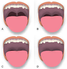 Oct 01, 2020 · benign neoplasm of tongue. References In Changes In Difficult Airway Predictors Following Mandibular Setback Surgery International Journal Of Oral And Maxillofacial Surgery