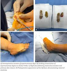 Image result for Supernumerary Digit