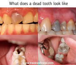 Maybe you would like to learn more about one of these? What Does A Dead Tooth Look Like Trace Wellness
