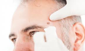 Cancer records show that doctors diagnosed it's possible to find this cancer early because it begins on the skin. Trends In Merkel Cell Carcinoma Physician S Weekly