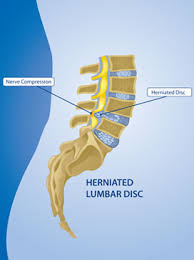 Check spelling or type a new query. Herniated Disc Herniated Disc Treatment Surgery Dr Kraus