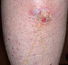 Here, you will find difficulty breathing and the start of organ failure. Cellulitis Sepsis Alliance