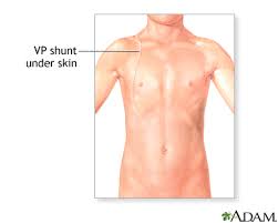 Ventriculoperitoneal Shunting Multimedia Encyclopedia Health Information St Luke S Hospital