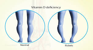 Image result for Rickets