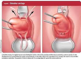 What does the cervix feel like during ovulation? Where Is Cervix In Early Pregnancy
