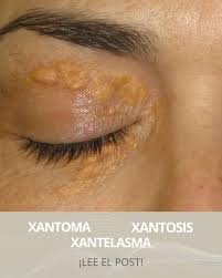 Image result for xantelasma