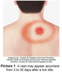 Image result for infected tick bite