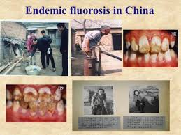 Fluorosis develops because of excessive accumulation in the body of fluoride. Endemic Fluorosis And Its Health Effects Open Parachute